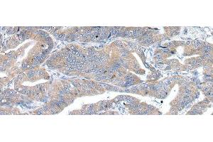 Immunohistochemistry of paraffin-embedded Human esophagus cancer using RAB2A Polyclonal Antibody at dilution of 1/40 (RAB2A antibody)