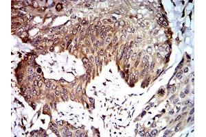Immunohistochemical analysis of paraffin-embedded esophageal cancer tissues using UFD1L mouse mAb with DAB staining. (UFD1L antibody  (AA 208-307))