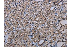The image on the left is immunohistochemistry of paraffin-embedded Human thyroid cancer tissue using ABIN7191353(MAGEC1 Antibody) at dilution 1/30, on the right is treated with synthetic peptide. (MAGEC1 antibody)