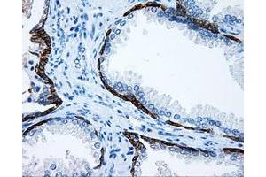 Immunohistochemical staining of paraffin-embedded Carcinoma of liver tissue using anti-MCL1 mouse monoclonal antibody. (MCL-1 antibody)