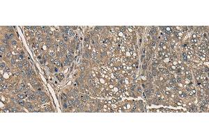 Immunohistochemistry of paraffin-embedded Human liver cancer tissue using CD5 Polyclonal Antibody at dilution of 1:35(x200) (CD5 antibody)