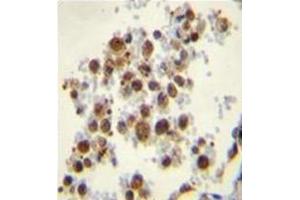 Formalin fixed, paraffin embedded human lung tissue stained with TBXAS1 Antibody  followed by peroxidase conjugation of the secondary antibody and DAB staining. (TBXAS1 antibody  (Middle Region))