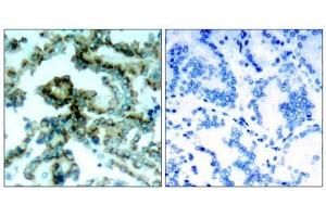 Immunohistochemical analysis of paraffin-embedded human lung carcinoma tissue, using PKCβ (phospho-Thr641) antibody (E011172).