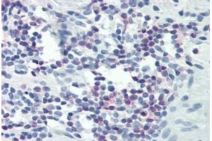 Human Colon, Lymphocytes (formalin-fixed, paraffin-embedded) stained with PLCG1 antibody ABIN337039 at 1:25-1:100 followed by biotinylated goat anti-rabbit IgG secondary antibody ABIN481713, alkaline phosphatase-streptavidin and chromogen. (Phospholipase C gamma 1 antibody  (C-Term))
