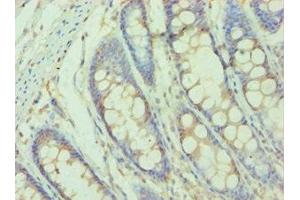 Immunohistochemistry of paraffin-embedded human colon tissue using ABIN7155523 at dilution of 1:100 (SMYD3 antibody  (AA 199-428))