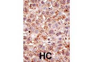 Formalin-fixed and paraffin-embedded human cancer tissue reacted with the primary antibody, which was peroxidase-conjugated to the secondary antibody, followed by DAB staining. (PIAS2 antibody  (N-Term))