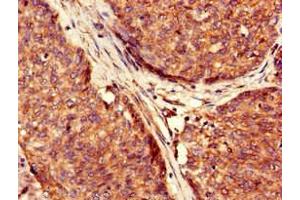 Immunohistochemistry of paraffin-embedded human ovarian cancer using ABIN7174352 at dilution of 1:100 (USP6 antibody  (C-Term))
