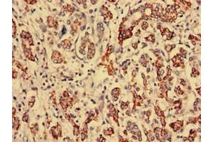 Immunohistochemistry analysis of human breast cancer using ABIN7168269 at dilution of 1:100 (RTCD1 antibody  (AA 167-379))