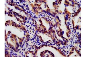 IHC image of ABIN7173883 diluted at 1:180 and staining in paraffin-embedded human lung cancer performed on a Leica BondTM system. (LTBR antibody  (AA 31-224))