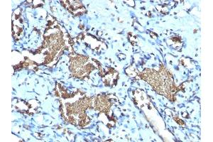 Formalin-fixed, paraffin-embedded human Angiosarcoma stained with Glycophorin A Rabbit Recombinant Monoclonal Antibody (GYPA/1725R). (Recombinant CD235a/GYPA antibody)