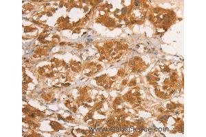 Immunohistochemistry of Human breast cancer using CPB1 Polyclonal Antibody at dilution of 1:50 (CPB1 antibody)