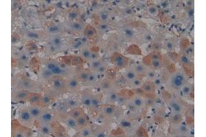 Detection of PADI4 in Human Liver cancer Tissue using Polyclonal Antibody to Peptidyl Arginine Deiminase Type IV (PADI4) (PAD4 antibody  (AA 1-300))