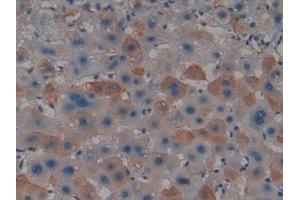 Detection of PADI4 in Human Liver cancer Tissue using Polyclonal Antibody to Peptidyl Arginine Deiminase Type IV (PADI4) (PAD4 antibody  (AA 1-300))