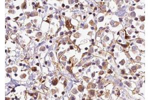 ABIN6277670 at 1/100 staining Human breast cancer tissue by IHC-P. (CTNNA1 antibody  (Internal Region))