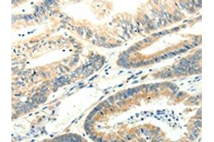 The image on the left is immunohistochemistry of paraffin-embedded Human colon cancer tissue using ABIN7131272(SYT5 Antibody) at dilution 1/15, on the right is treated with fusion protein. (Synaptotagmin V antibody)
