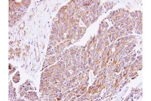 IHC-P Image Immunohistochemical analysis of paraffin-embedded human endometrial cancer, using cGK1, antibody at 1:500 dilution. (PRKG1 antibody  (Center))