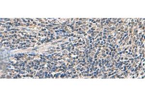 Immunohistochemistry of paraffin-embedded Human cervical cancer tissue using ATP5F1D Polyclonal Antibody at dilution of 1:55(x200) (ATP5F1D antibody)