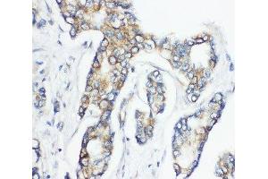IHC-P: CD1d antibody testing of human breast cancer tissue (CD1d antibody  (AA 76-92))
