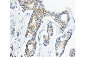 IHC-P: CD1d antibody testing of human breast cancer tissue