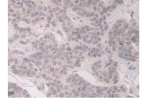 DAB staining on IHC-P;Samples:Human Pancreas Cancer Tissue) (ORM1 antibody  (AA 19-201))