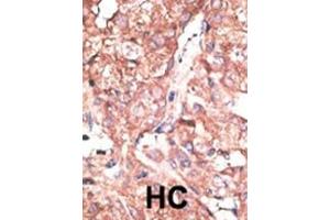 Formalin-fixed and paraffin-embedded human cancer tissue reacted with the primary antibody, which was peroxidase-conjugated to the secondary antibody, followed by DAB staining. (ATG4B antibody  (C-Term))