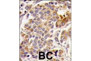 Formalin-fixed and paraffin-embedded human breast carcinoma tissue reacted with PRKAA1-pS487, which was peroxidase-conjugated to the secondary antibody, followed by DAB staining. (AMPK alpha antibody  (AA 474-502))