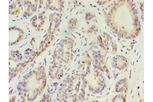 Immunohistochemistry of paraffin-embedded human breast cancer using ABIN7157372 at dilution of 1:100 (Keratin 10 antibody  (AA 1-584))