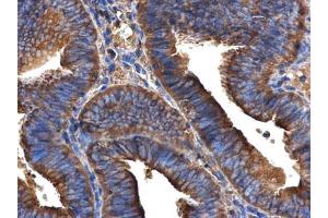 IHC-P Image ARFIP2 antibody [N1C2] detects ARFIP2 protein at cytoplasm in human endometrial cancer by immunohistochemical analysis. (ARFIP2 antibody)
