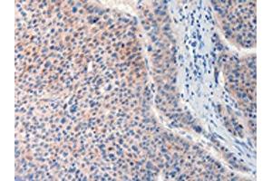 The image on the left is immunohistochemistry of paraffin-embedded Human liver cancer tissue using ABIN7190632(FAT4 Antibody) at dilution 1/20, on the right is treated with synthetic peptide. (FAT4 antibody)