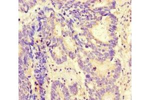 Immunohistochemistry of paraffin-embedded human colon cancer using ABIN7165797 at dilution of 1:100