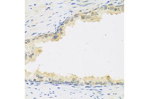 Immunohistochemistry of paraffin-embedded human prostate using LIF antibody (ABIN5974705) at dilution of 1/100 (40x lens). (LIF antibody)