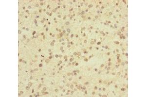 Immunohistochemistry of paraffin-embedded human glioma using ABIN7174279 at dilution of 1:100 (USP2 antibody  (C-Term))