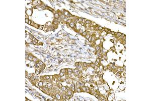 Immunohistochemistry of paraffin-embedded human lung cancer using β-Tubulin Rabbit pAb (ABIN3020552, ABIN3020553 and ABIN3020554) at dilution of 1:250 (40x lens). (TUBB antibody  (AA 40-260))