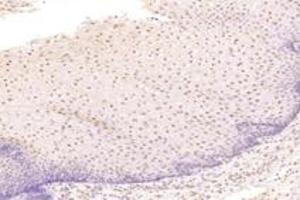 Immunohistochemistry analysis of paraffin-embedded human esophageal cancer using TBX10 (ABIN7075814) at dilution of 1: 4600 (T-Box 10 antibody)
