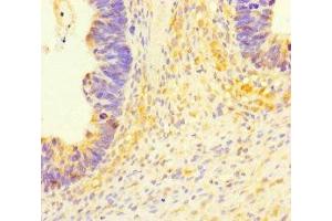 Immunohistochemistry of paraffin-embedded human ovarian cancer using ABIN7174658 at dilution of 1:100 (Solute Carrier Family 35 (UDP-GlcNAc/UDP-Glucose Transporter), Member D2 (SLC35D2) (AA 75-146) antibody)