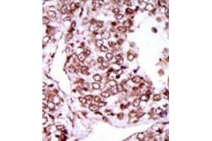 Formalin-fixed and paraffin-embedded human cancer tissue (hepatocarcinoma) reacted with the primary antibody, which was peroxidase-conjugated to the secondary antibody, followed by AEC staining. (CAMKII gamma antibody  (C-Term))