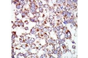 IHC analysis of FFPE human hepatocarcinoma tissue stained with the TAK1 antibody