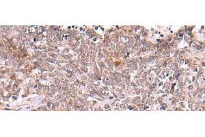 Immunohistochemistry of paraffin-embedded Human lung cancer tissue using TRMT12 Polyclonal Antibody at dilution of 1:80(x200) (TRMT12 antibody)
