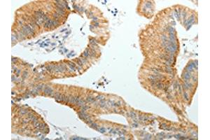 The image on the left is immunohistochemistry of paraffin-embedded Human colon cancer tissue using ABIN7191855(PGBD5 Antibody) at dilution 1/10, on the right is treated with synthetic peptide. (PGBD5 antibody)
