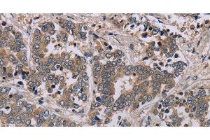 Immunohistochemistry of paraffin-embedded Human liver cancer tissue using AATK Polyclonal Antibody at dilution 1:45 (AATK antibody)