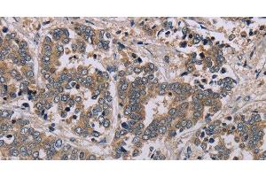 Immunohistochemistry of paraffin-embedded Human liver cancer tissue using AATK Polyclonal Antibody at dilution 1:45