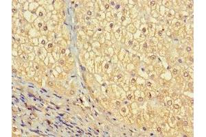 Immunohistochemistry of paraffin-embedded human liver cancer using ABIN7175557 at dilution of 1:100 (Vitronectin antibody  (AA 31-105))