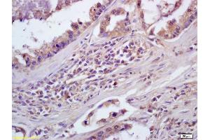 Formalin-fixed and paraffin embedded human lung carcinoma labeled with Anti-CD84/SLAMF5 Polyclonal Antibody, Unconjugated (ABIN741465) at 1:200, followed by conjugation to the secondary antibody and DAB staining (CD84 antibody  (AA 231-329))