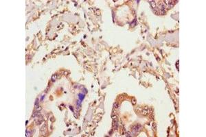 Immunohistochemistry of paraffin-embedded human pancreatic cancer using ABIN7141994 at dilution of 1:100 (MICAL2 antibody  (AA 1-495))