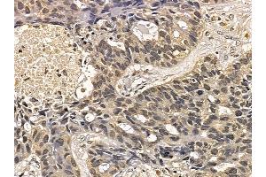 AurB Mouse Monoclonal Antibody at 1/100 staining human lung cancer and adjacent non-tumor tissue by IHC-P.