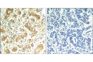 Immunohistochemical analysis of paraffin-embedded human breast carcinoma tissue using syk (Ab-323) Antibody (E021546). (SYK antibody)