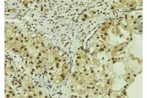 ABIN6267097 at 1/100 staining Human breast cancer tissue by IHC-P. (Beclin 1 antibody  (pSer15))