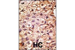 Formalin-fixed and paraffin-embedded human cancer tissue reacted with the primary antibody, which was peroxidase-conjugated to the secondary antibody, followed by AEC staining. (ACE2 antibody  (N-Term))