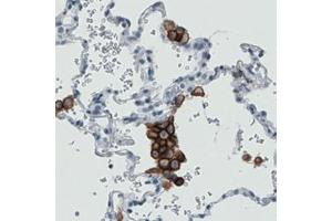 Immunohistochemical staining (Formalin-fixed paraffin-embedded sections) of human lung with MRC1 monoclonal antibody, clone CL0387  shows strong immunoreactivity in macrophages. (Macrophage Mannose Receptor 1 antibody)