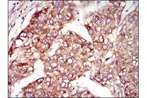 Immunohistochemical analysis of paraffin-embedded liver cancer tissues using MAP1LC3A mouse mAb with DAB staining. (MAP1LC3A antibody  (AA 1-121))